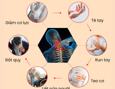 NGUYÊN NHÂN & GIẢI PHÁP TRỊ TÊ BÌ BÀN TAY, NGÓN TAY