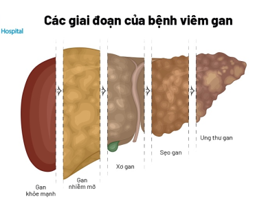 6 thói quen buổi tối âm thầm phá hủy lá gan 