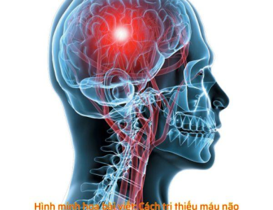 Biến chứng thiếu máu não do thoái hóa đốt sống cổ