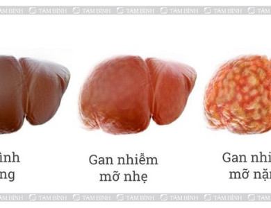 Bác sĩ cảnh báo: Những sai lầm phổ biến khiến người gầy cũng bị gan nhiễm mỡ