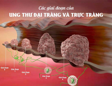 Phát hiện ung thư đại tràng từ dấu hiệu sụt cân