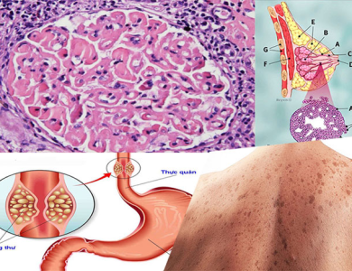 Đi ngoài phân đen bệnh nhân ung thư dạ dày sốc mất máu, suy đa cơ quan