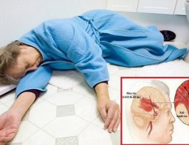 Đột quỵ là gì? Các biện pháp phòng ngừa đột quỵ từ sớm