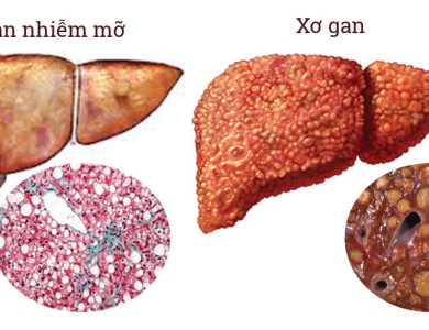 Lý do người gầy vẫn bị gan nhiễm mỡ