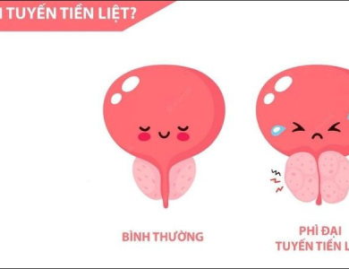 4 biểu hiện của phì đại tuyến tiền liệt nam giới cần biết