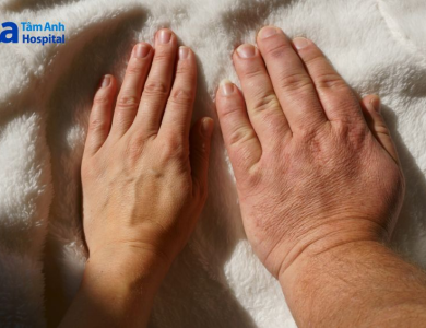 Bỗng dưng bàn tay, bàn chân to ra: Có thể là dấu hiệu bệnh lý nguy hiểm