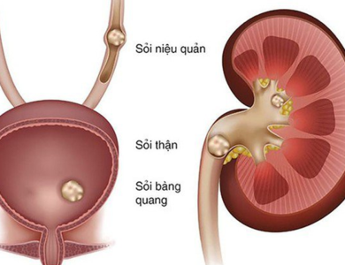 Cách ăn uống tốt nhất giúp ngăn ngừa hình thành sỏi thận