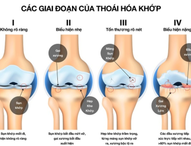 Vì sao lỏng gối sau thay khớp nhân tạo?