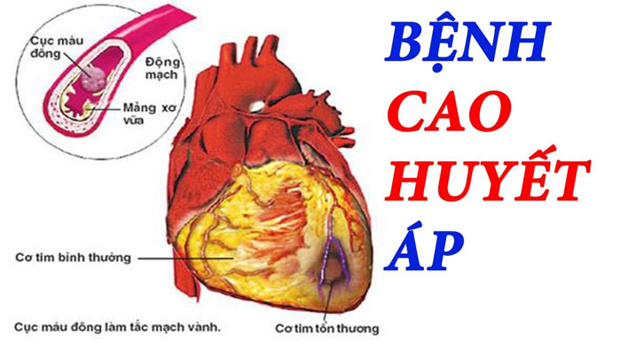 5 sai lầm buổi tối khiến huyết áp tăng mà nhiều người không biết