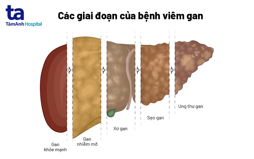 6 thói quen buổi tối âm thầm phá hủy lá gan 