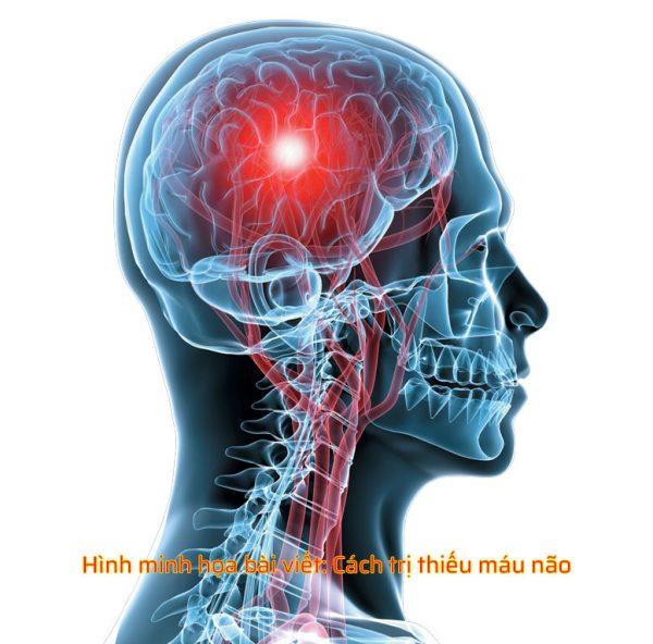 Biến chứng thiếu máu não do thoái hóa đốt sống cổ