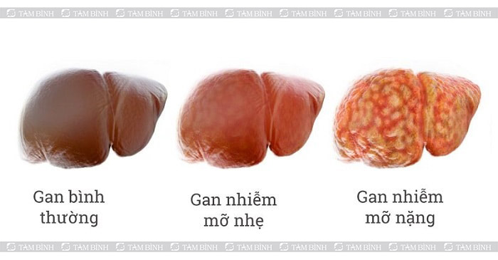 Bác sĩ cảnh báo: Những sai lầm phổ biến khiến người gầy cũng bị gan nhiễm mỡ