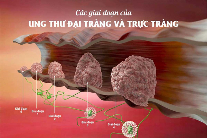 Phát hiện ung thư đại tràng từ dấu hiệu sụt cân