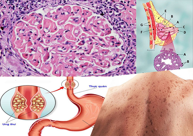 Đi ngoài phân đen bệnh nhân ung thư dạ dày sốc mất máu, suy đa cơ quan