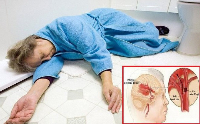 Đột quỵ là gì? Các biện pháp phòng ngừa đột quỵ từ sớm