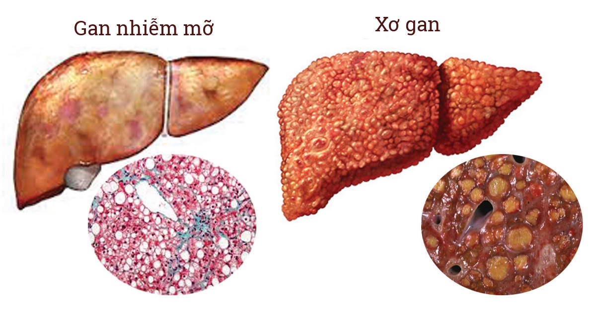 Lý do người gầy vẫn bị gan nhiễm mỡ