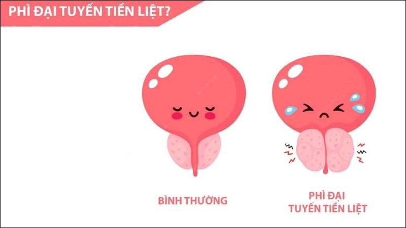 4 biểu hiện của phì đại tuyến tiền liệt nam giới cần biết