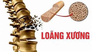 Phụ nữ tuổi nào nên phòng ngừa loãng xương?