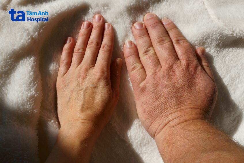 Bỗng dưng bàn tay, bàn chân to ra: Có thể là dấu hiệu bệnh lý nguy hiểm