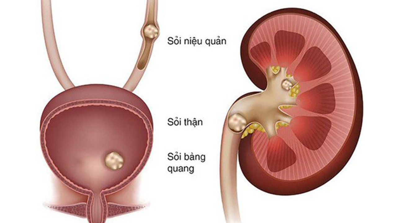 Cách ăn uống tốt nhất giúp ngăn ngừa hình thành sỏi thận