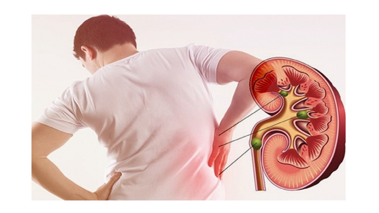 6 nguyên nhân gây sỏi thận nhiều người mắc phải
