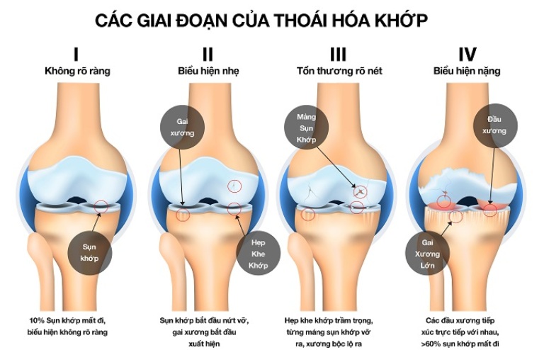 Vì sao lỏng gối sau thay khớp nhân tạo?